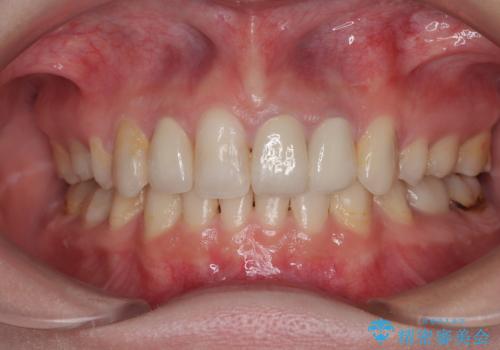 気になっていたむし歯と前歯のデコボコ 矯正治療とむし歯治療の総合歯科治療の症例 治療後