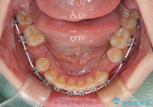 気になる八重歯 ワイヤー装置での抜歯矯正の治療中