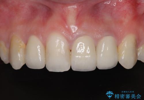 気になっていたむし歯と前歯のデコボコ 矯正治療とむし歯治療の総合歯科治療の治療後