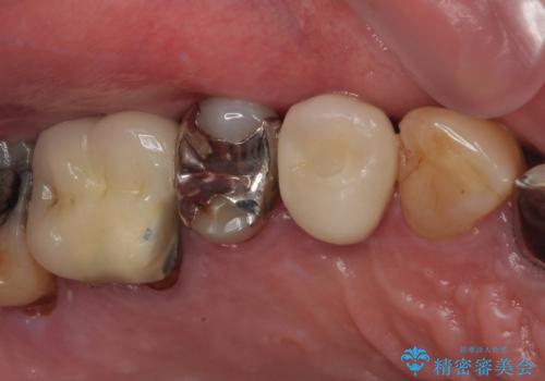 抜歯は避けたい? 1DAYインプラントに魅せられて抜歯即時埋入インプラントによる補綴治療の症例 治療後