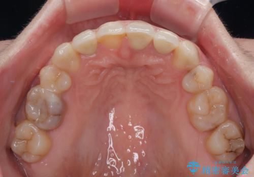気になっていたむし歯と前歯のデコボコ 矯正治療とむし歯治療の総合歯科治療の治療後