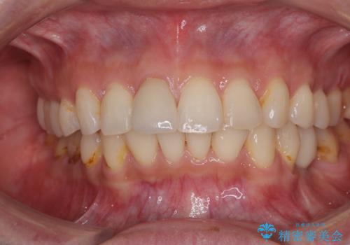 デコボコと乳歯の欠損 ワイヤー矯正とインプラント補綴治療の症例 治療後