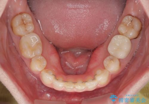 気になっていたむし歯と前歯のデコボコ 矯正治療とむし歯治療の総合歯科治療の治療後