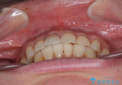 デコボコと乳歯の欠損 ワイヤー矯正とインプラント補綴治療の治療後