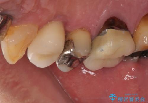 抜歯は避けたい? 1DAYインプラントに魅せられて抜歯即時埋入インプラントによる補綴治療の治療後