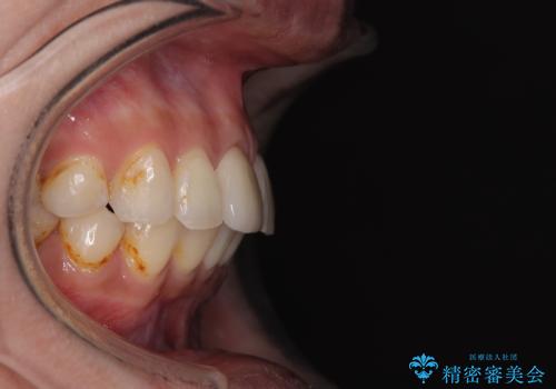 デコボコと乳歯の欠損 ワイヤー矯正とインプラント補綴治療の治療後