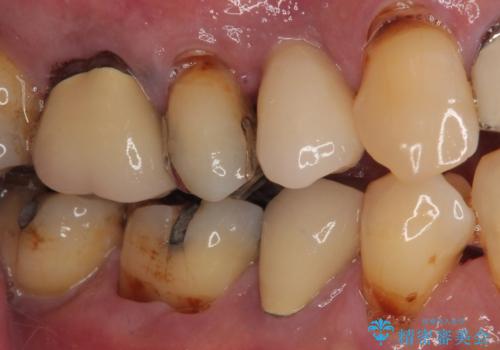 抜歯は避けたい? 1DAYインプラントに魅せられて抜歯即時埋入インプラントによる補綴治療の治療後
