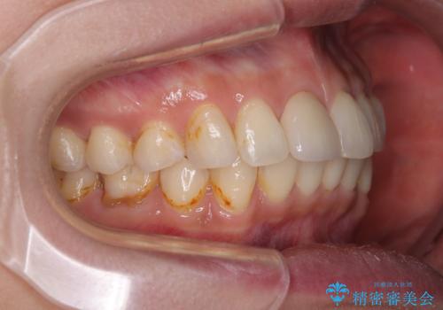 デコボコと乳歯の欠損 ワイヤー矯正とインプラント補綴治療の治療後