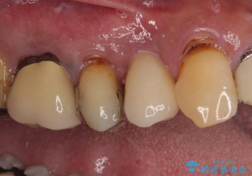 抜歯は避けたい? 1DAYインプラントに魅せられて抜歯即時埋入インプラントによる補綴治療の治療後