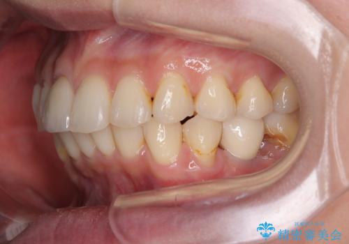 デコボコと乳歯の欠損 ワイヤー矯正とインプラント補綴治療の治療後