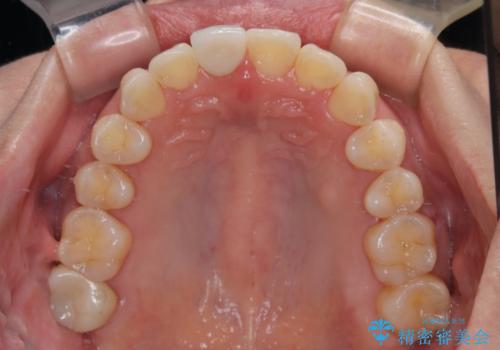 デコボコと乳歯の欠損 ワイヤー矯正とインプラント補綴治療の治療後