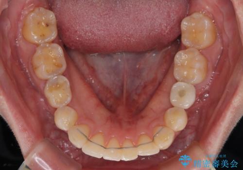 デコボコと乳歯の欠損 ワイヤー矯正とインプラント補綴治療の治療後
