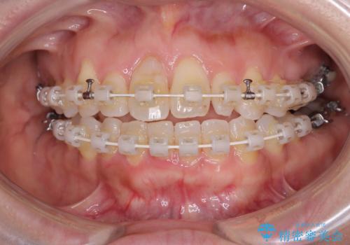 骨格的なズレを歯列矯正でカバー ワイヤー装置での非抜歯矯正の治療中