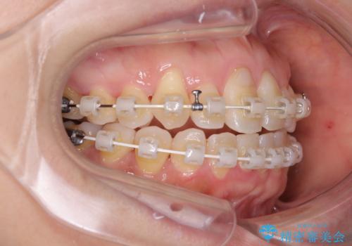 骨格的なズレを歯列矯正でカバー ワイヤー装置での非抜歯矯正の治療中
