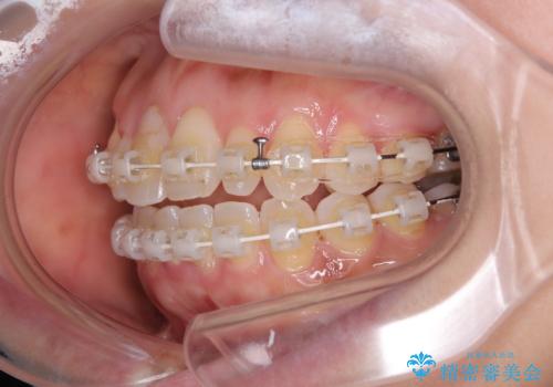 骨格的なズレを歯列矯正でカバー ワイヤー装置での非抜歯矯正の治療中