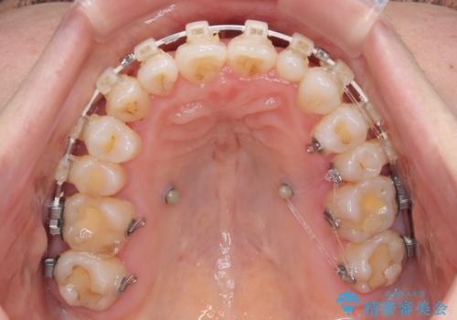 骨格的なズレを歯列矯正でカバー ワイヤー装置での非抜歯矯正の治療中