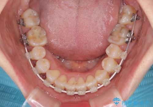 骨格的なズレを歯列矯正でカバー　ワイヤー装置での非抜歯矯正の治療中