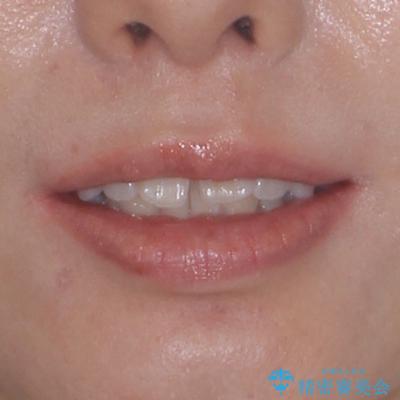 深い咬み合わせによる隙間 インビザライン矯正でコンプレックスを改善の治療前(顔貌)