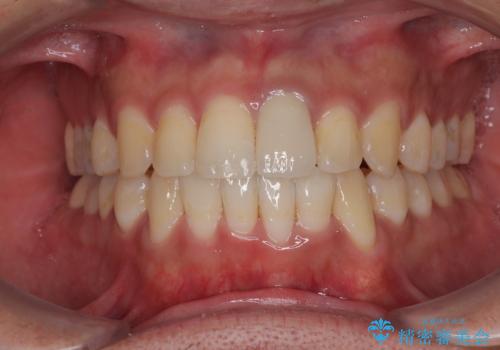 気になる前歯のデコボコと八重歯 ワイヤー矯正ですっきりとの治療後