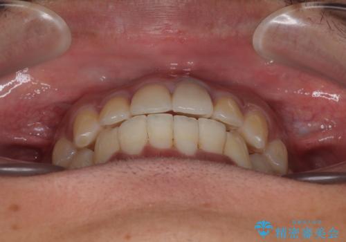 気になる前歯のデコボコと八重歯 ワイヤー矯正ですっきりとの治療後