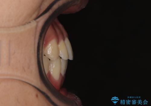 気になる前歯のデコボコと八重歯 ワイヤー矯正ですっきりとの治療後