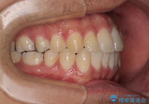 気になる前歯のデコボコと八重歯 ワイヤー矯正ですっきりとの治療後
