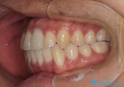 気になる前歯のデコボコと八重歯 ワイヤー矯正ですっきりとの治療後