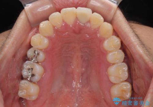 気になる前歯のデコボコと八重歯 ワイヤー矯正ですっきりとの治療後