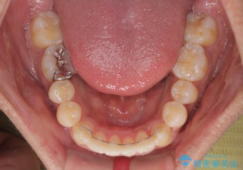 気になる前歯のデコボコと八重歯 ワイヤー矯正ですっきりとの治療後