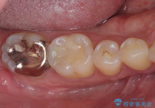 違和感が続く奥歯 慎重な診断を行ったむし歯治療の症例 治療前
