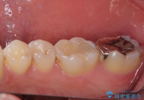 違和感が続く奥歯 慎重な診断を行ったむし歯治療の治療前