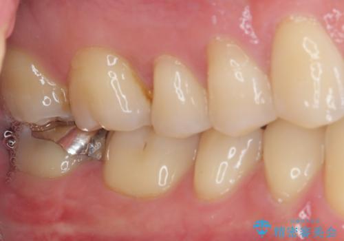 違和感が続く奥歯 慎重な診断を行ったむし歯治療の治療前