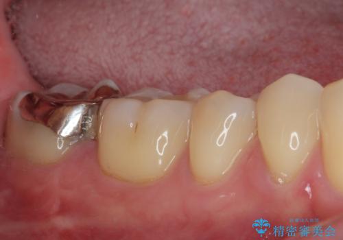 違和感が続く奥歯 慎重な診断を行ったむし歯治療の治療前