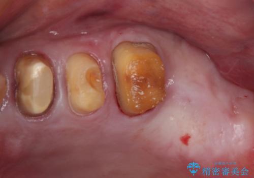 強い咬合力で奥歯がボロボロに インプラント治療による咬合回復と全顎セラミック治療の治療前