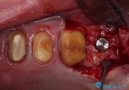 強い咬合力で奥歯がボロボロに インプラント治療による咬合回復と全顎セラミック治療の治療中