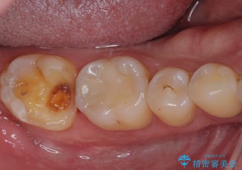 違和感が続く奥歯 慎重な診断を行ったむし歯治療の治療中