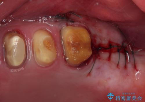強い咬合力で奥歯がボロボロに インプラント治療による咬合回復と全顎セラミック治療の治療後
