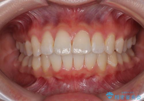深い咬み合わせによる隙間 インビザライン矯正でコンプレックスを改善の症例 治療後