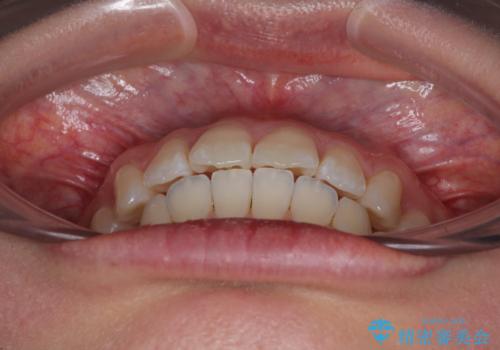 深い咬み合わせによる隙間 インビザライン矯正でコンプレックスを改善の治療後