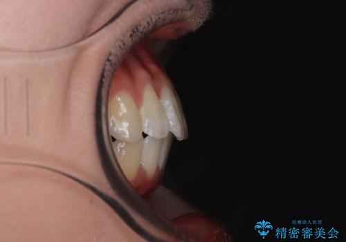 深い咬み合わせによる隙間 インビザライン矯正でコンプレックスを改善の治療後