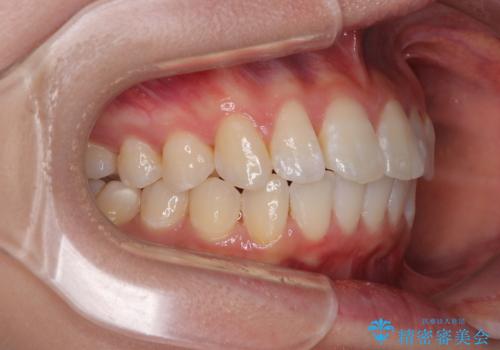 深い咬み合わせによる隙間 インビザライン矯正でコンプレックスを改善の治療後