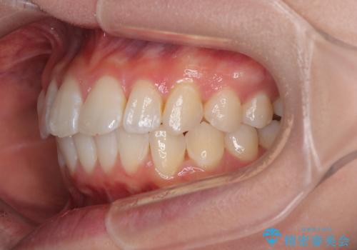 深い咬み合わせによる隙間 インビザライン矯正でコンプレックスを改善の治療後