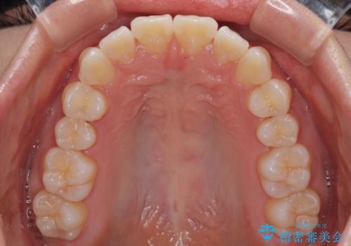 深い咬み合わせによる隙間 インビザライン矯正でコンプレックスを改善の治療後