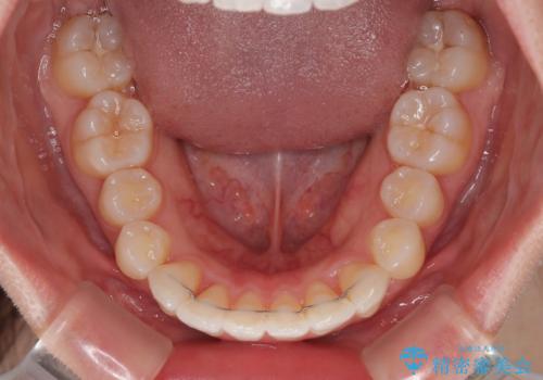 深い咬み合わせによる隙間 インビザライン矯正でコンプレックスを改善の治療後