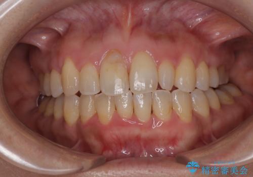 骨格的なズレを歯列矯正でカバー ワイヤー装置での非抜歯矯正の症例 治療後