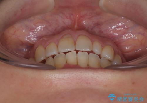 骨格的なズレを歯列矯正でカバー ワイヤー装置での非抜歯矯正の治療後