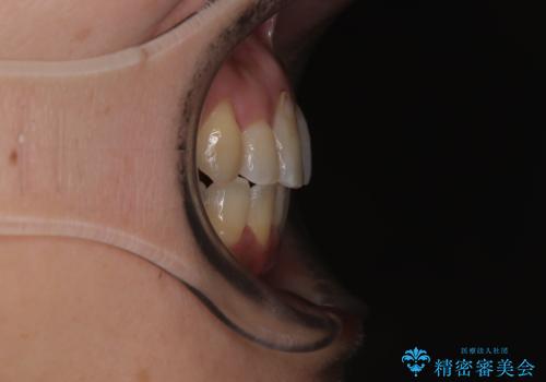 骨格的なズレを歯列矯正でカバー ワイヤー装置での非抜歯矯正の治療後