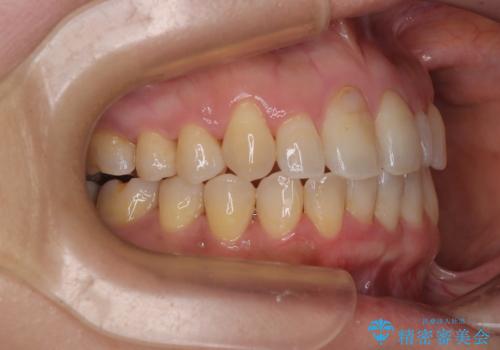 骨格的なズレを歯列矯正でカバー ワイヤー装置での非抜歯矯正の治療後