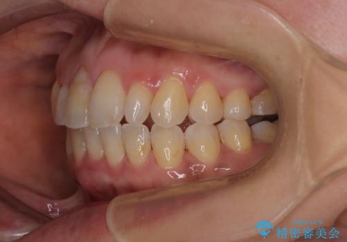 骨格的なズレを歯列矯正でカバー ワイヤー装置での非抜歯矯正の治療後