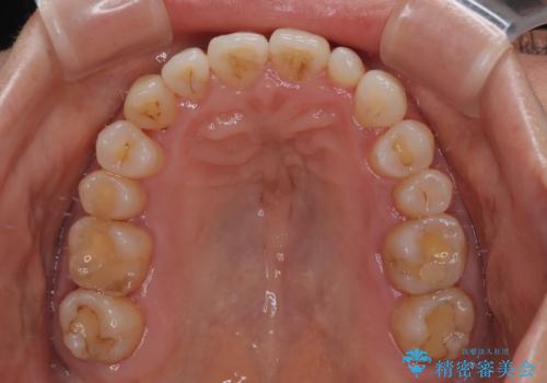 骨格的なズレを歯列矯正でカバー　ワイヤー装置での非抜歯矯正の治療後